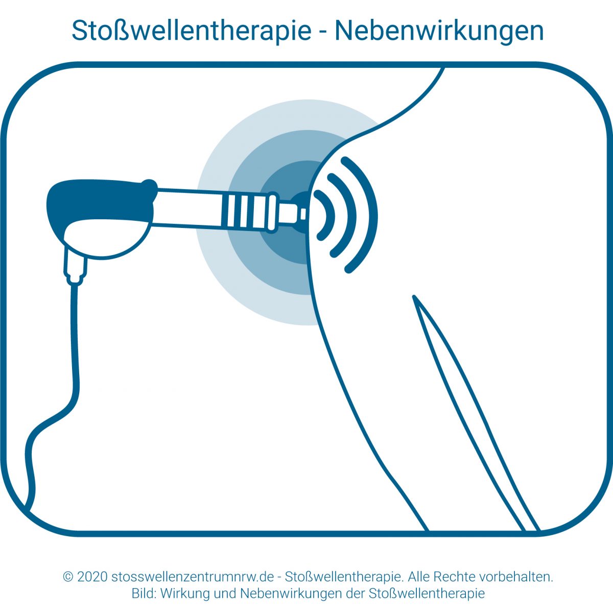 Stoßwellentherapie